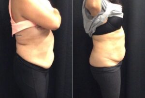 B&A Lady Abdomen Side