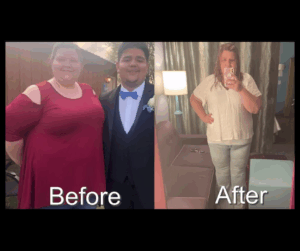 Before After Photos GLP-1